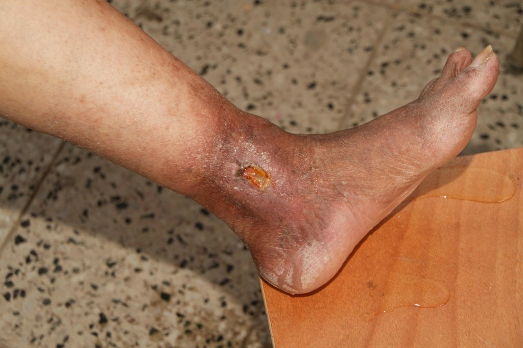 Рожистое воспаление ноги: симптомы и лечение