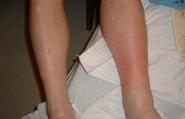воспаление ноги: симптомы и лечение