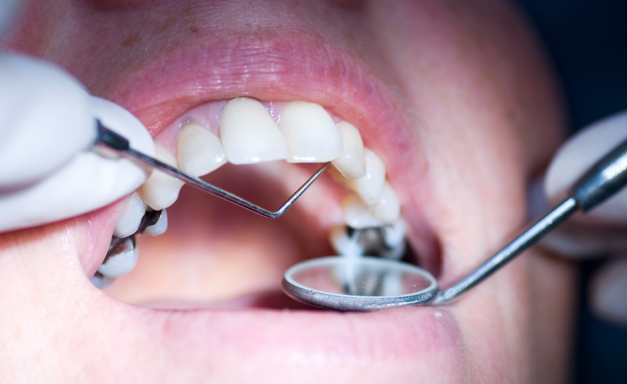 Важным условием лечения вазомоторного ринита является лечение больных зубов
