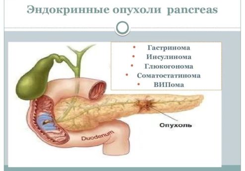 Доброкачественные опухоли поджелудочной железы презентация