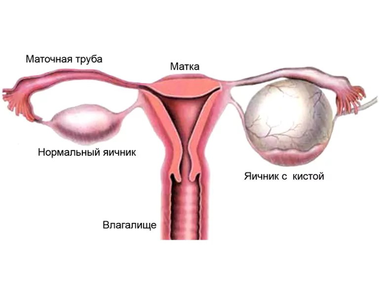 Какие существуют виды кист
