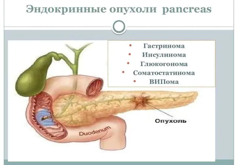 Эндокринные опухоли поджелудочной железы